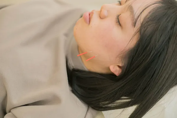 美容鍼の施術風景